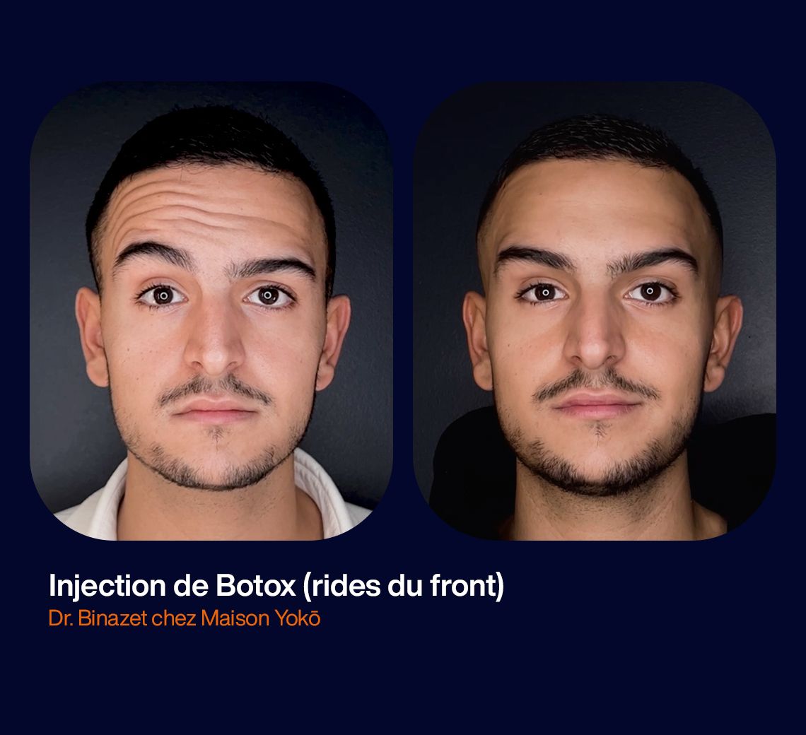 Botox Avant et après Multiesthetique fr Multiesthetique fr