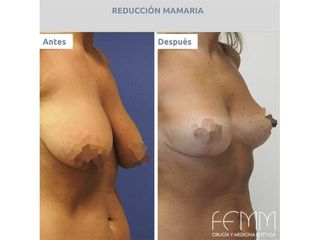 Reducción de senos - Clínica FEMM