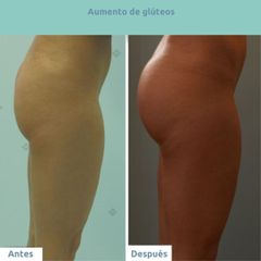 Aumento de glúteos - Clínica FEMM