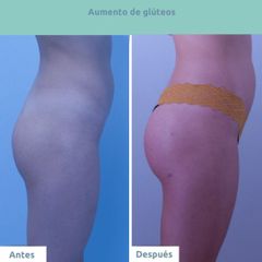 Aumento de glúteos - Clínica FEMM