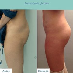 Aumento de glúteos - Clínica FEMM
