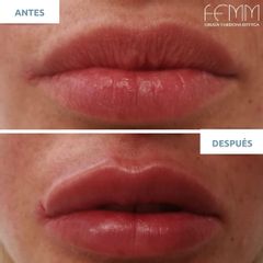 Aumento de labios - Clínica FEMM