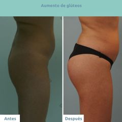 Aumento glúteos - Clínica FEMM