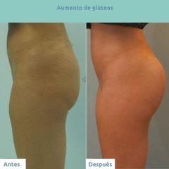 Aumento glúteos - Clínica FEMM