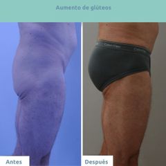 Aumento glúteos - Clínica FEMM