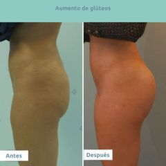 Aumento de glúteos - Clínica FEMM