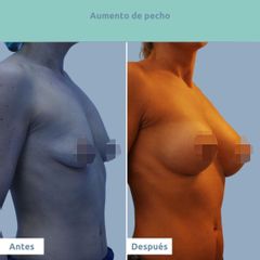 Aumento de pecho - Clínica FEMM