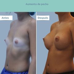 Aumento de pecho - Clínica FEMM