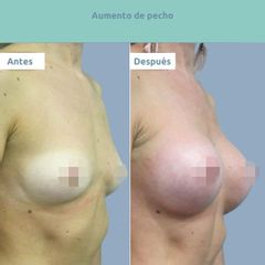 Aumento de pecho - Clínica FEMM