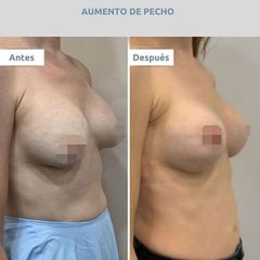 Aumento de pecho - Clínica FEMM