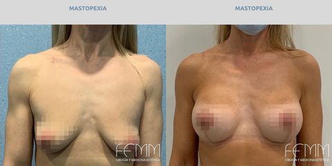 Mastopexia - Clínica FEMM