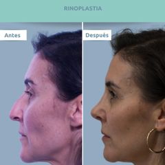 Rinoplastia - Clínica FEMM