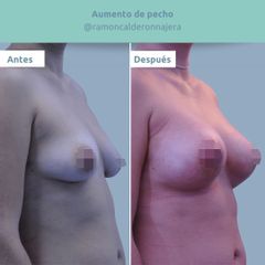 Aumento de pecho - Clínica FEMM