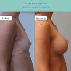 Aumento de pecho - Clínica FEMM