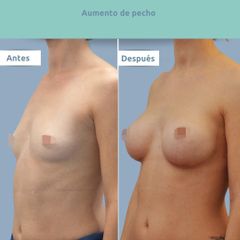Aumento de pecho - Clínica FEMM