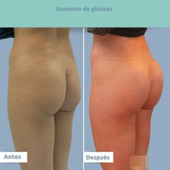 Aumento de glúteos - Clínica FEMM