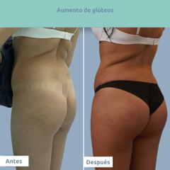 Aumento de glúteos - Clínica FEMM