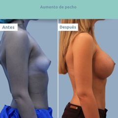 Aumento de pecho - Clínica FEMM