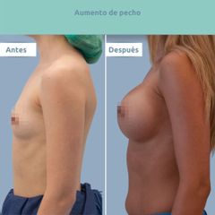 Aumento de pecho - Clínica FEMM