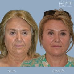 Lifting - Clínica FEMM