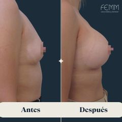 Aumento mamario - Clínica FEMM