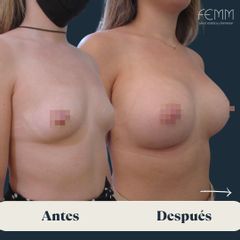 Aumento mamario - Clínica FEMM