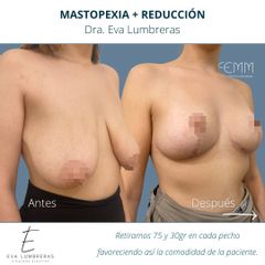 Reducción mamaria - Clínica FEMM