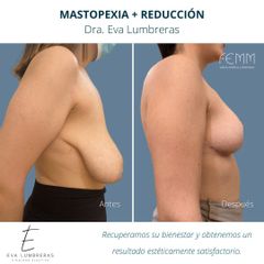 Reducción mamaria - Clínica FEMM