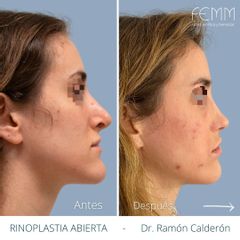 Rinoplastia - Clínica FEMM