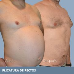Plicatura de rectos - Clínica FEMM