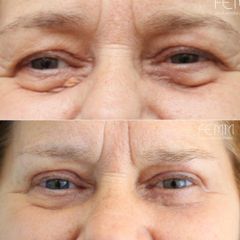 Blefaroplastia - Clínica FEMM