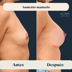 Aumento de pecho con prótesis anatómicas  - Clínica FEMM