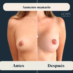 Aumento de pecho con prótesis anatómicas - Clínica FEMM