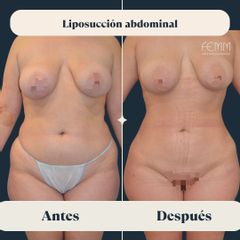 Liposucción abdominal - Clínica FEMM