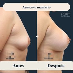 Aumento de pecho con prótesis redondas - Clínica FEMM