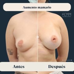 Aumento de pecho con prótesis redondas - Clínica FEMM