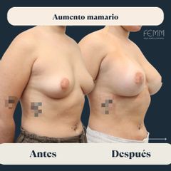 Aumento de pecho con prótesis redondas - Clínica FEMM