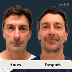 Rinoplastia masculina - Clínica FEMM