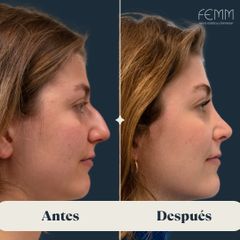 Rinoplastia abierta - Clínica FEMM