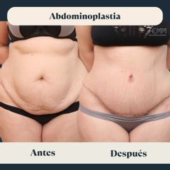 Abdominoplastia - Clínica FEMM