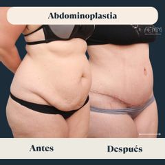 Abdominoplastia - Clínica FEMM