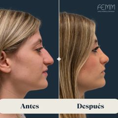 Rinoplastia abierta en paciente femenina - Clínica FEMM