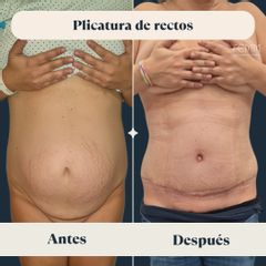 Plicatura de rectos - Clínica FEMM