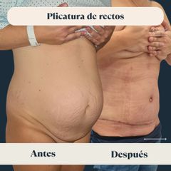 Plicatura de rectos - Clínica FEMM
