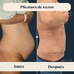 Plicatura de rectos - Clínica FEMM