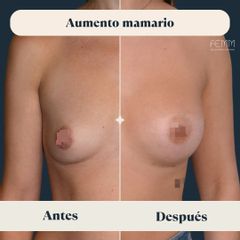 Aumento mamario - Clínica FEMM