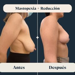 Mastopexia y reducción mamaria - Clínica FEMM