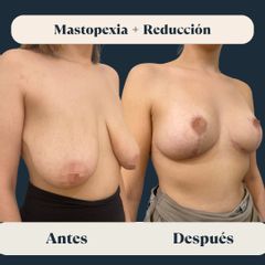 Mastopexia y reducción mamaria - Clínica FEMM