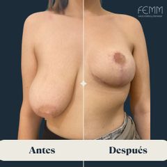 Mastopexia y reducción mamaria - Clínica FEMM