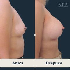 Aumento de pecho con prótesis de 300 cc retropectorales - Clínica FEMM
